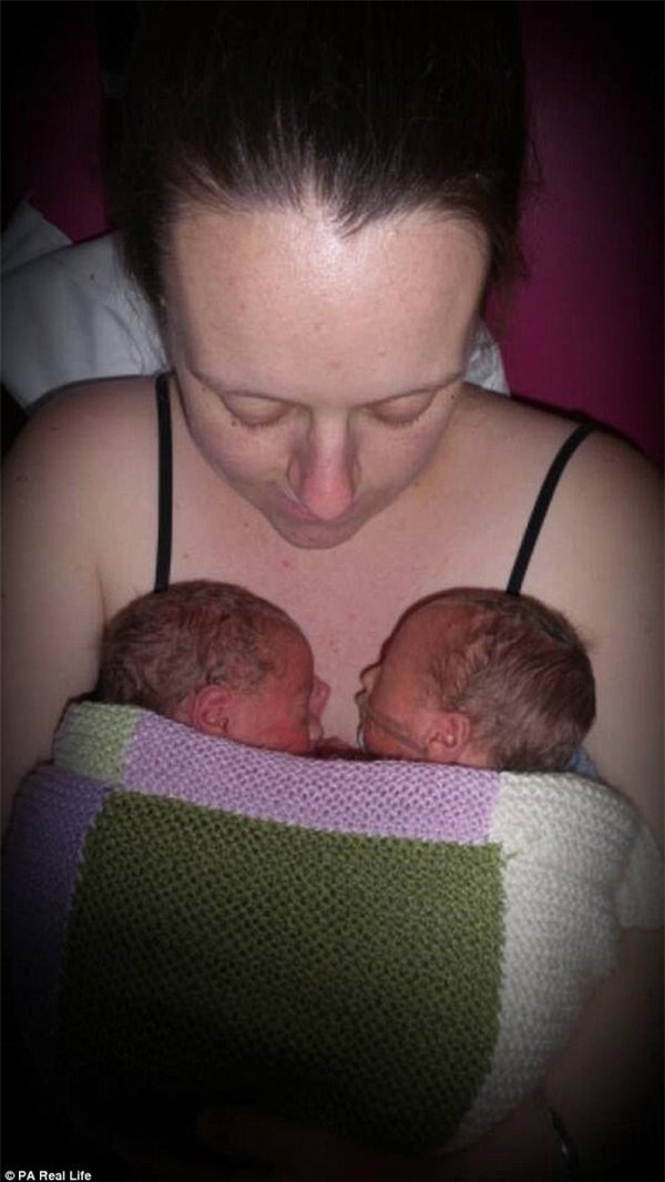 thai ky gap nguy hiem, hai be song sinh thoat chet nho om nhau trong bung me - 5