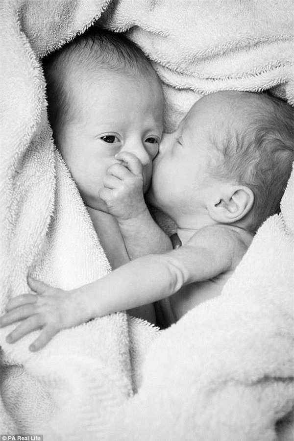 thai ky gap nguy hiem, hai be song sinh thoat chet nho om nhau trong bung me - 6