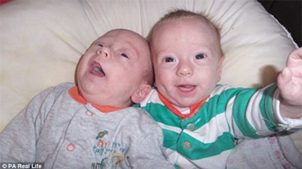 thai ky gap nguy hiem, hai be song sinh thoat chet nho om nhau trong bung me - 8