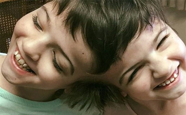 Hai bé sinh đôi dính liền đầu bác sĩ nói sau 1 ngày là chết, và đây là hình ảnh sau 11 năm - Ảnh 2.