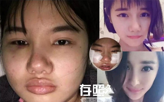 Thời buổi bây giờ đã hâm mộ cuồng nhiệt là phải phẫu thuật thẩm mỹ cho xinh đẹp giống thần tượng cơ! - Ảnh 1.