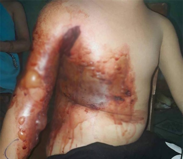 Nghịch dại bé 5 tuổi bỏng nặng, mẹ thiếu tiền đành cho con xuất viện sớm để dùng thuốc nam khiến con bị hoại tử