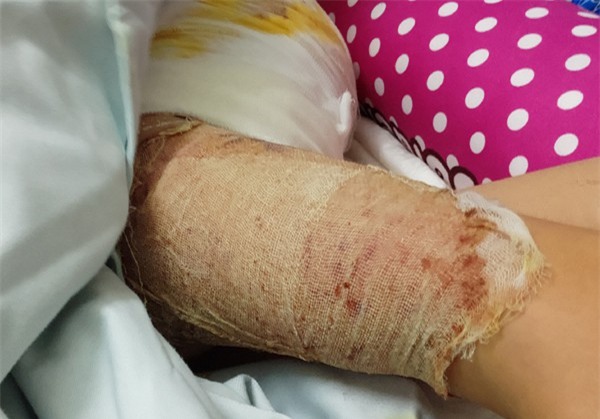 Nghịch dại bé 5 tuổi bỏng nặng, mẹ thiếu tiền đành cho con xuất viện sớm để dùng thuốc nam khiến con bị hoại tử