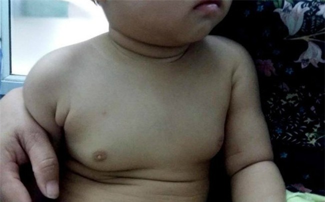 Bé gái 2 tuổi ngực to như 18 tuổi vì "ăn thuốc tránh thai" của mẹ