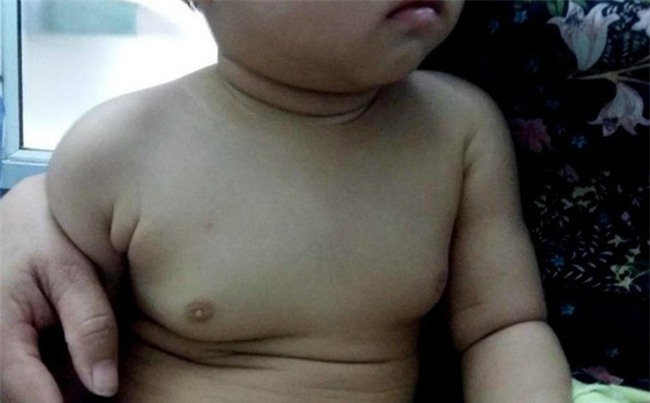 Bé gái 2 tuổi ngực to như 18 tuổi vì