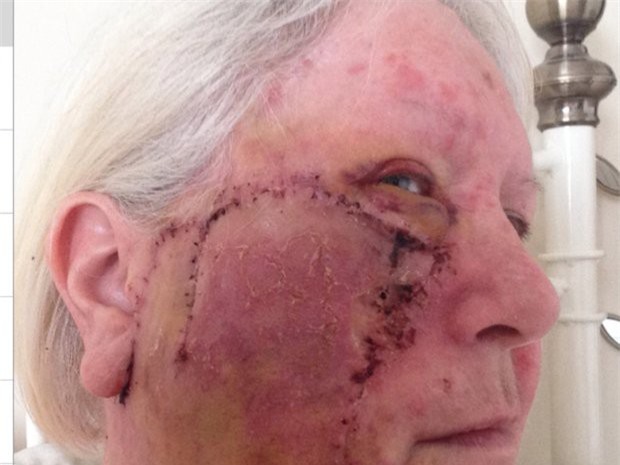 Thích nhuộm da tắm nắng, quý bà bị khoét lỗ sâu hoắm trên mặt do ung thư - Ảnh 2.