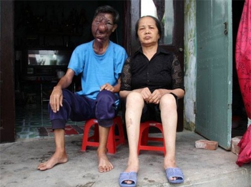 Sóng gió cuộc đời của người đàn ông mang gương mặt quỷ