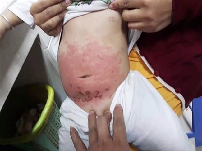 me dung dau gio bat can, be 14 thang tuoi bi bong - 1