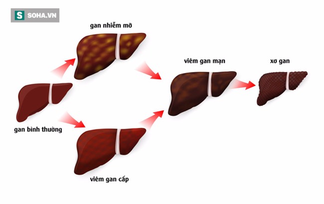 Chuyên gia: Muốn phòng ung thư gan, thay vì 3 sớm phải tiến hành 6 sớm mới đủ an toàn - Ảnh 1.
