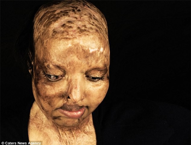 10 năm sau vụ tạt axit kinh hoàng, cô gái trẻ đã tìm được tình yêu của đời dù phải mang gương mặt ác quỷ - Ảnh 1.