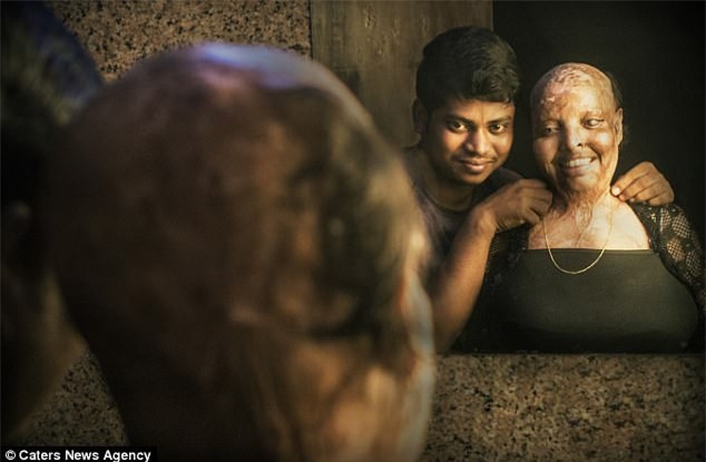 10 năm sau vụ tạt axit kinh hoàng, cô gái trẻ đã tìm được tình yêu của đời dù phải mang gương mặt ác quỷ - Ảnh 3.