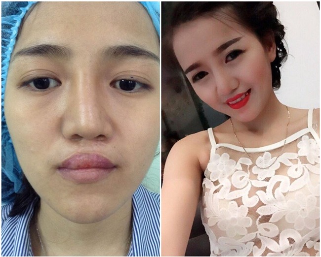 phau thuat tham my thanh cong, co gai tre hanh phuc sau bao nam "khong muon soi guong" - 1