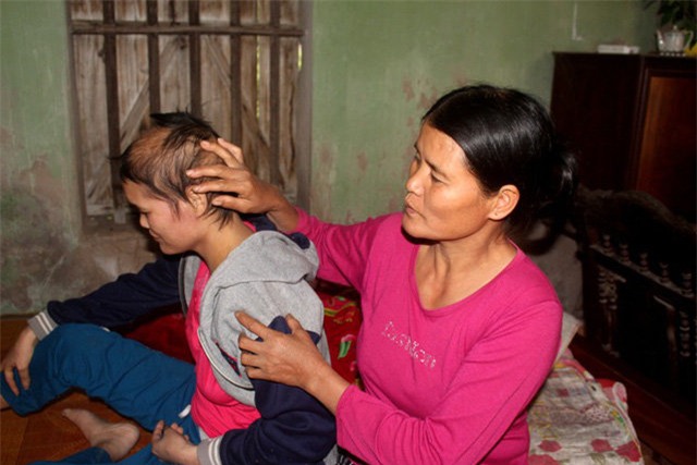 am anh cau noi cua co gai mac ung thu di can va 7 lan vuot can khong thanh - 3