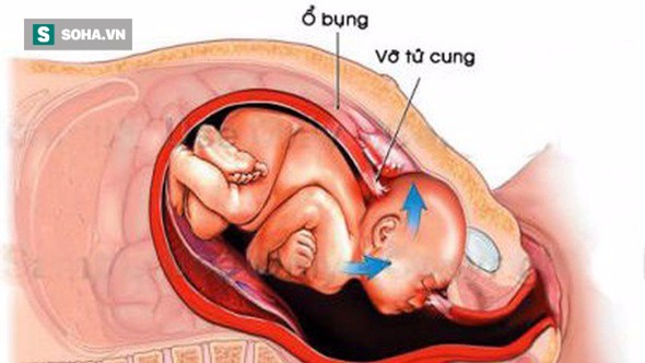 Vỡ tử cung - tai biến sản khoa cực kỳ nguy hiểm: Chuyên gia khuyến cáo cách phòng ngừa - Ảnh 1.