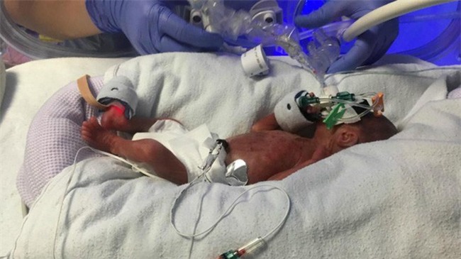 Đẻ non khi mới 23 tuần tuổi, cậu bé nặng chưa đầy nửa kg vẫn sống sót thần kỳ - Ảnh 2.