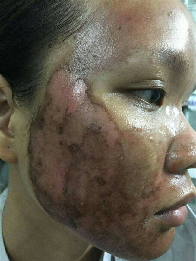 Ký ức kinh hoàng sau lần làm đẹp dại dột đến bỏng rộp cả mặt của cô gái trẻ - Ảnh 1.