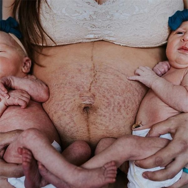 nhin vung bung "nhau nhi" sau sinh cua me, con trai lon ngac nhien: "bung me bi lam sao vay?" - 3