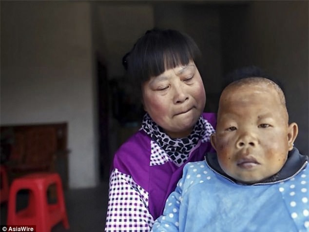 Sinh ra đứa trẻ quái dị, người đời xui vứt con đi nhưng bà mẹ vẫn một mình nuôi nấng suốt 30 năm - Ảnh 2.