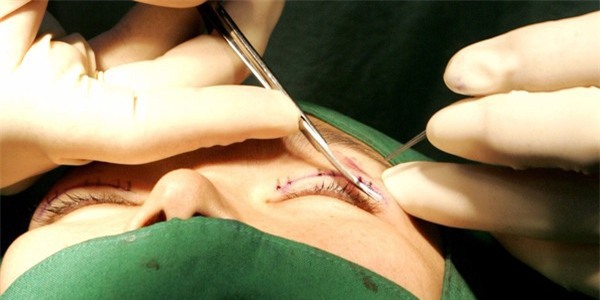 Là tiểu phẫu nhưng cắt mí hay bóc mỡ bọng mắt cũng có thể gây ra những hậu quả nhìn kinh khủng như thế này - Ảnh 1.