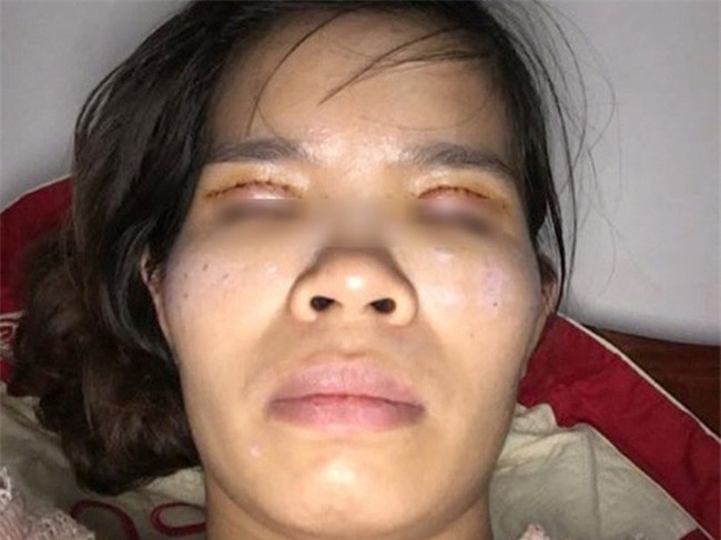 Là tiểu phẫu nhưng cắt mí hay bóc mỡ bọng mắt cũng có thể gây ra những hậu quả nhìn kinh khủng như thế này - Ảnh 12.