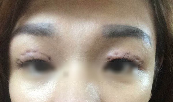 Là tiểu phẫu nhưng cắt mí hay bóc mỡ bọng mắt cũng có thể gây ra những hậu quả nhìn kinh khủng như thế này - Ảnh 15.