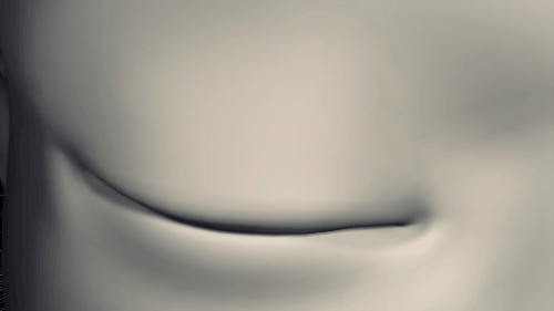 Là tiểu phẫu nhưng cắt mí hay bóc mỡ bọng mắt cũng có thể gây ra những hậu quả nhìn kinh khủng như thế này - Ảnh 2.