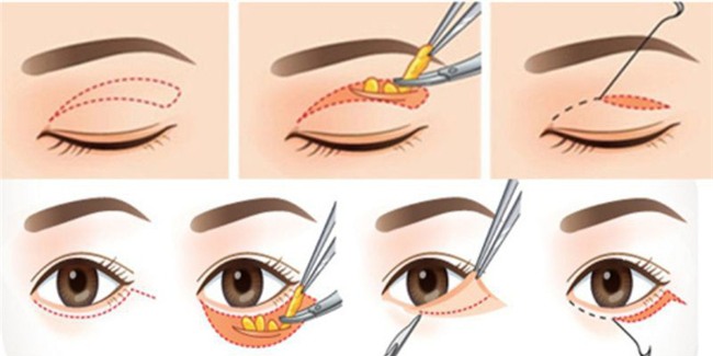 Là tiểu phẫu nhưng cắt mí hay bóc mỡ bọng mắt cũng có thể gây ra những hậu quả nhìn kinh khủng như thế này - Ảnh 6.