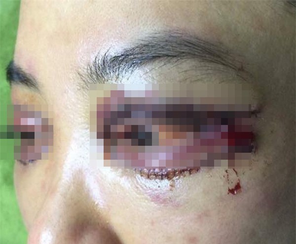 Là tiểu phẫu nhưng cắt mí hay bóc mỡ bọng mắt cũng có thể gây ra những hậu quả nhìn kinh khủng như thế này - Ảnh 9.