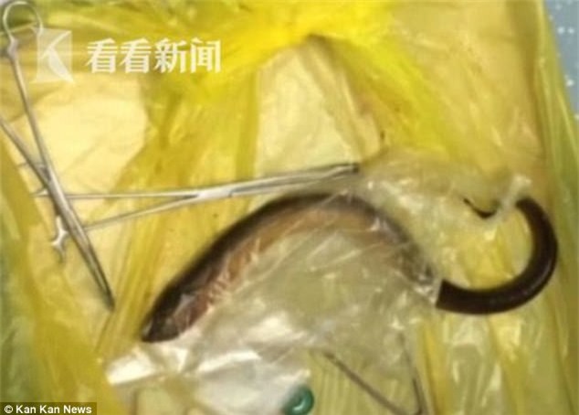 Chụp CT, bác sĩ phát hiện vật thể lạ trong bụng người đàn ông và không thể tin vào mắt mình khi lấy ra