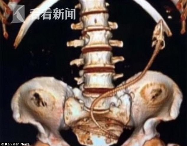 Chụp CT, bác sĩ phát hiện vật thể lạ trong bụng người đàn ông và không thể tin vào mắt mình khi lấy ra