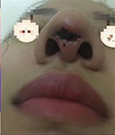 Những ca phẫu thuật thẩm mỹ khiến bệnh nhân biến dạng gây rúng động mạng xã hội-4