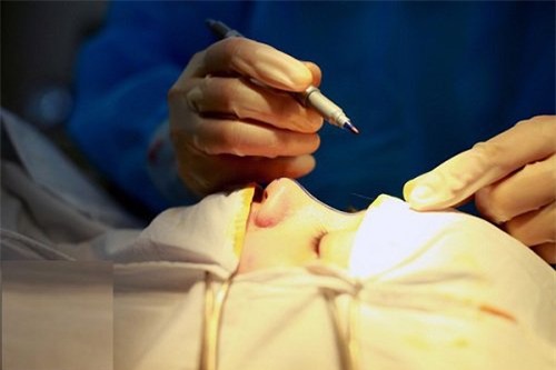 con sot lam dep mang ten "sua mui" dang lan rong den muc nao? - 1