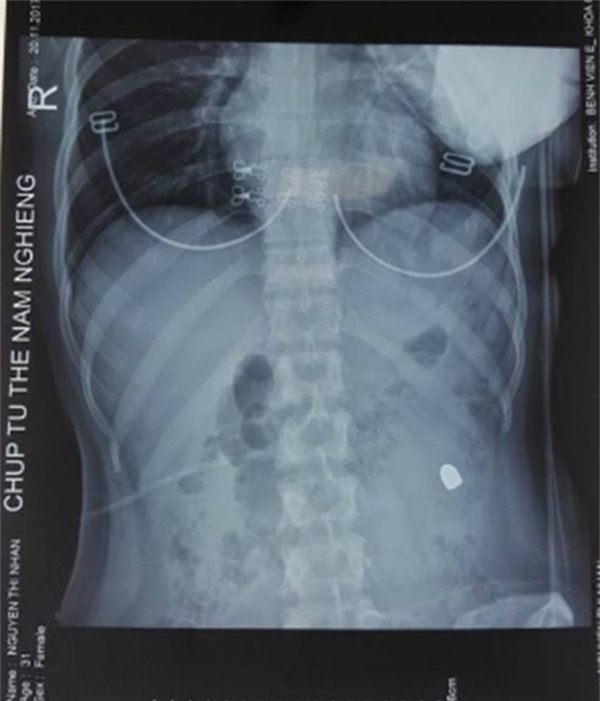 Cô gái bị đạn lạc bắn thủng bụng ngay trên đường ở Hà Nội - Ảnh 1.