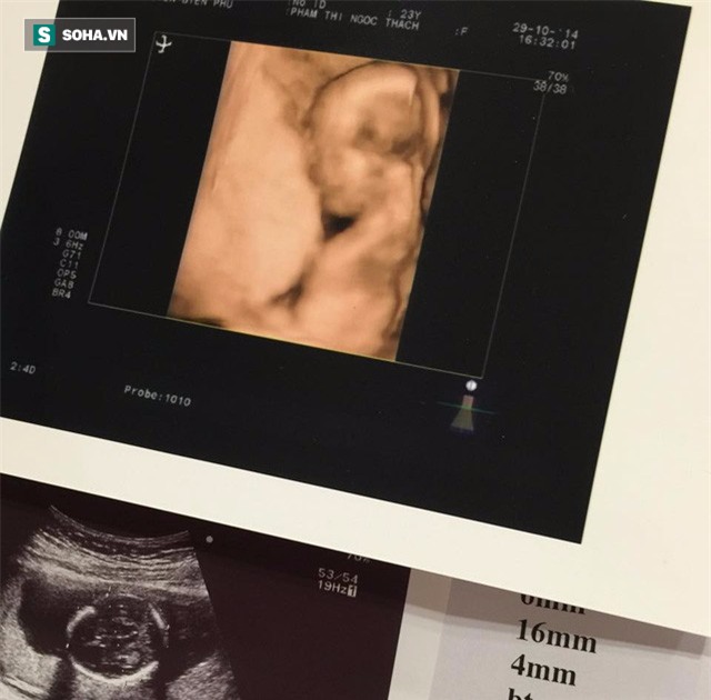 Bác sĩ sản khoa: 8 lưu ý cho mẹ bầu và thai nhi phòng tránh nguy cơ sinh non - Ảnh 2.