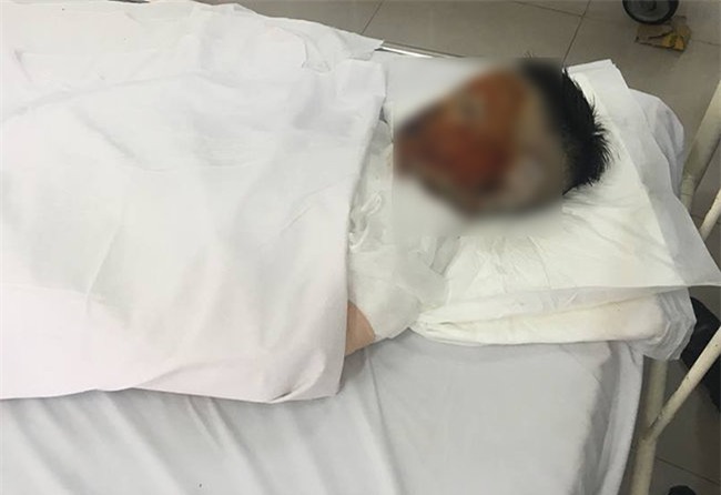 co gai 17 tuoi bat ngo bi tat axit tren duong di lam ve, nguy co mu 2 mat - 1