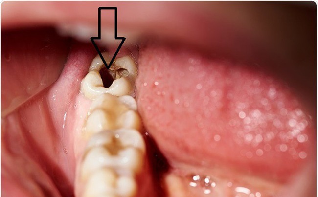 Tìm thấy 1 thực phẩm ngừa sâu và làm trắng răng an toàn, hiệu quả hơn cả kem thông thường