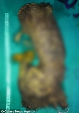 Phàn nàn vì đau bụng vài ngày sau khi sinh con, người phụ nữ đi phẫu thuật thì thấy thứ kinh dị này - Ảnh 1.