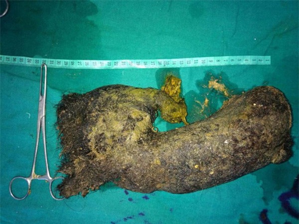 dau bung du doi 3 ngay sau khi sinh, bac si phat hien thu kinh di trong bung san phu - 1