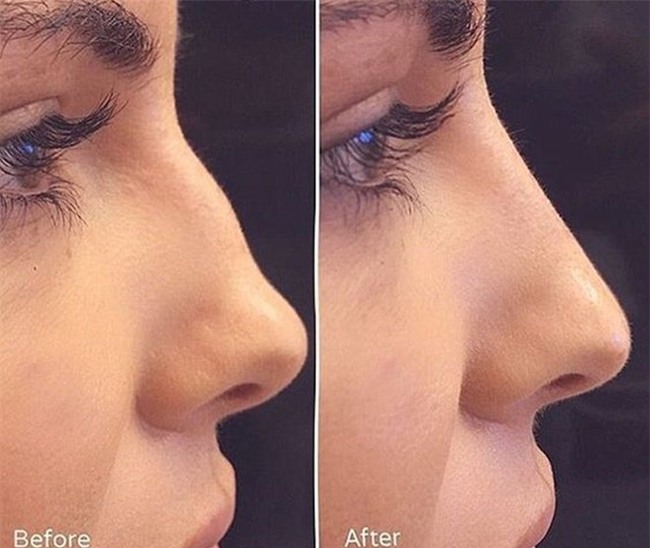 nang mui khong can cham dao keo: day la phuong phap lam mui hot nhat hien tai! - 3