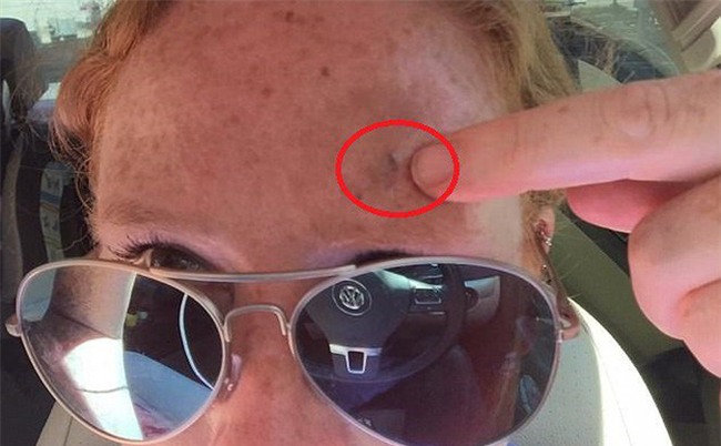 Bỗng xuất hiện nốt ruồi trên trán, cuộc đời của bà mẹ 2 con ở Mỹ hoàn toàn bị đảo lộn