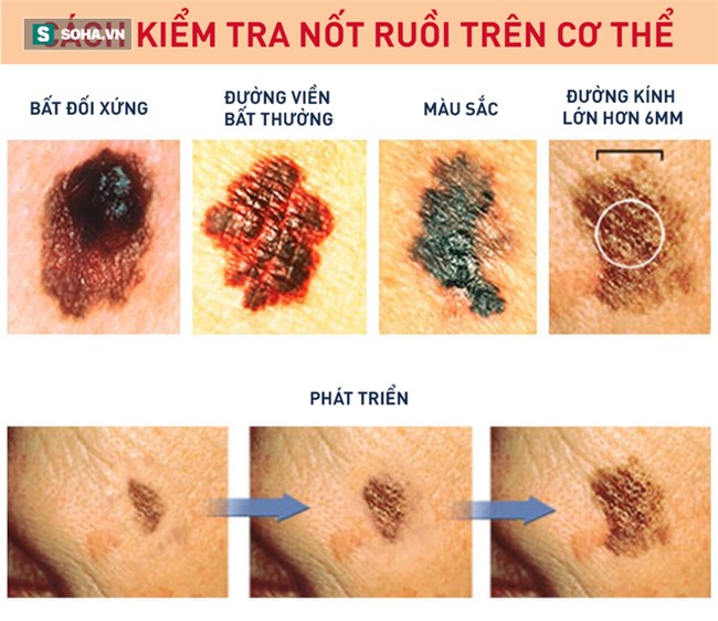 Bỗng xuất hiện nốt ruồi trên trán, cuộc đời của bà mẹ 2 con ở Mỹ hoàn toàn bị đảo lộn - Ảnh 2.