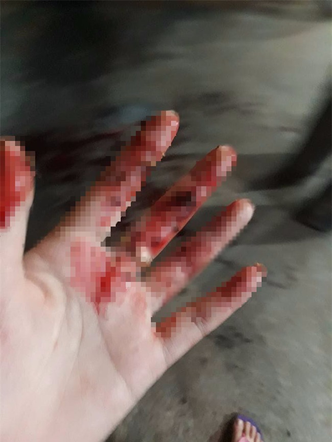 Đưa người gặp nạn vào bệnh viện, cô gái tốt bụng bị chính nạn nhân đánh rách môi, lệch sống mũi - Ảnh 2.