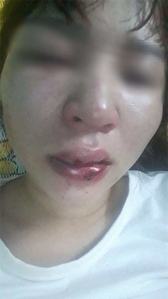 Đưa người gặp nạn vào bệnh viện, cô gái tốt bụng bị chính nạn nhân đánh rách môi, lệch sống mũi - Ảnh 5.