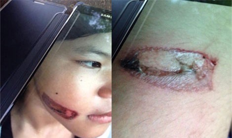 Bé gái bị bạo hành bằng sắt nung đỏ dí vào hai cánh tay - Ảnh 1.