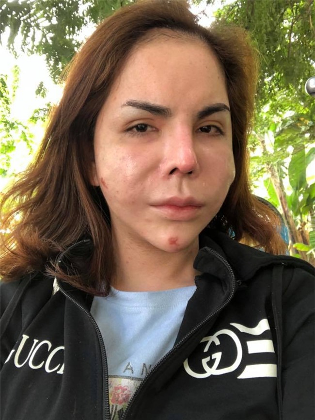 Phát hoảng với gương mặt biến dạng khủng khiếp sau thẩm mỹ của hot girl chuyển giới Linda-3