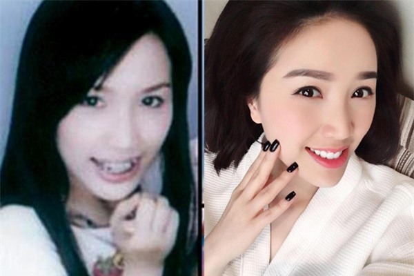 Muốn làm răng nên suy nghĩ lại cho thật kỹ rồi hãy quyết định!