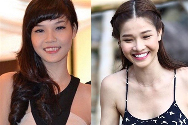 Muốn làm răng nên suy nghĩ lại cho thật kỹ rồi hãy quyết định!