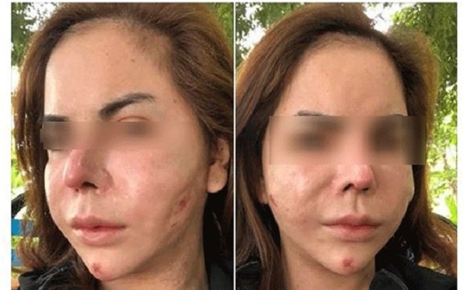 Đừng dại tiêm silicon giống hot girl chuyển giới Linda, mặt sẽ dần mấp mô biến dạng và không bao giờ lấy ra hết được