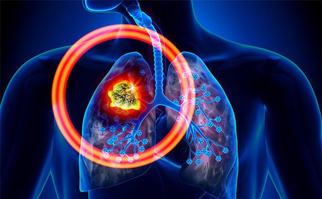 Đây là triệu chứng mà hầu hết dân văn phòng đều mắc nhưng cũng có thể là dấu hiệu ung thư