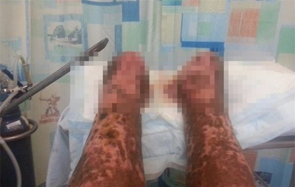 Vì vết xước chưa đến 1cm trên tay, người đàn ông phải cắt bỏ hai chân, chạy thận cả đời - Ảnh 4.